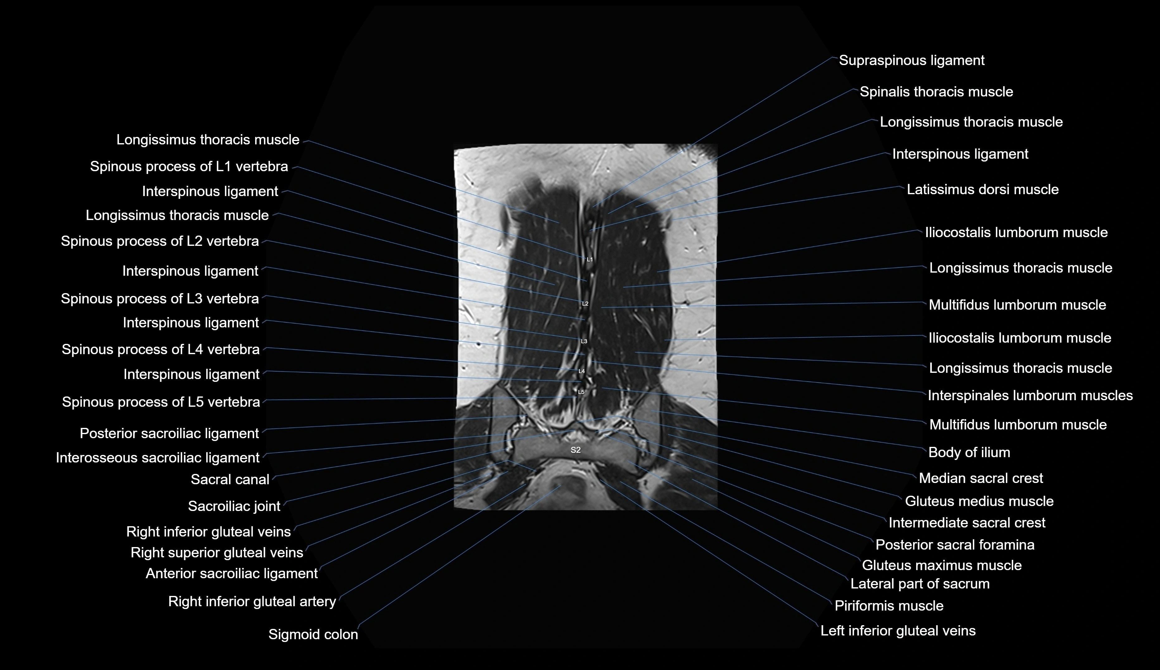 MRI lumbar spine coronal cross sectional anatomy 3T radiology  image-img-00001-00033.webp
